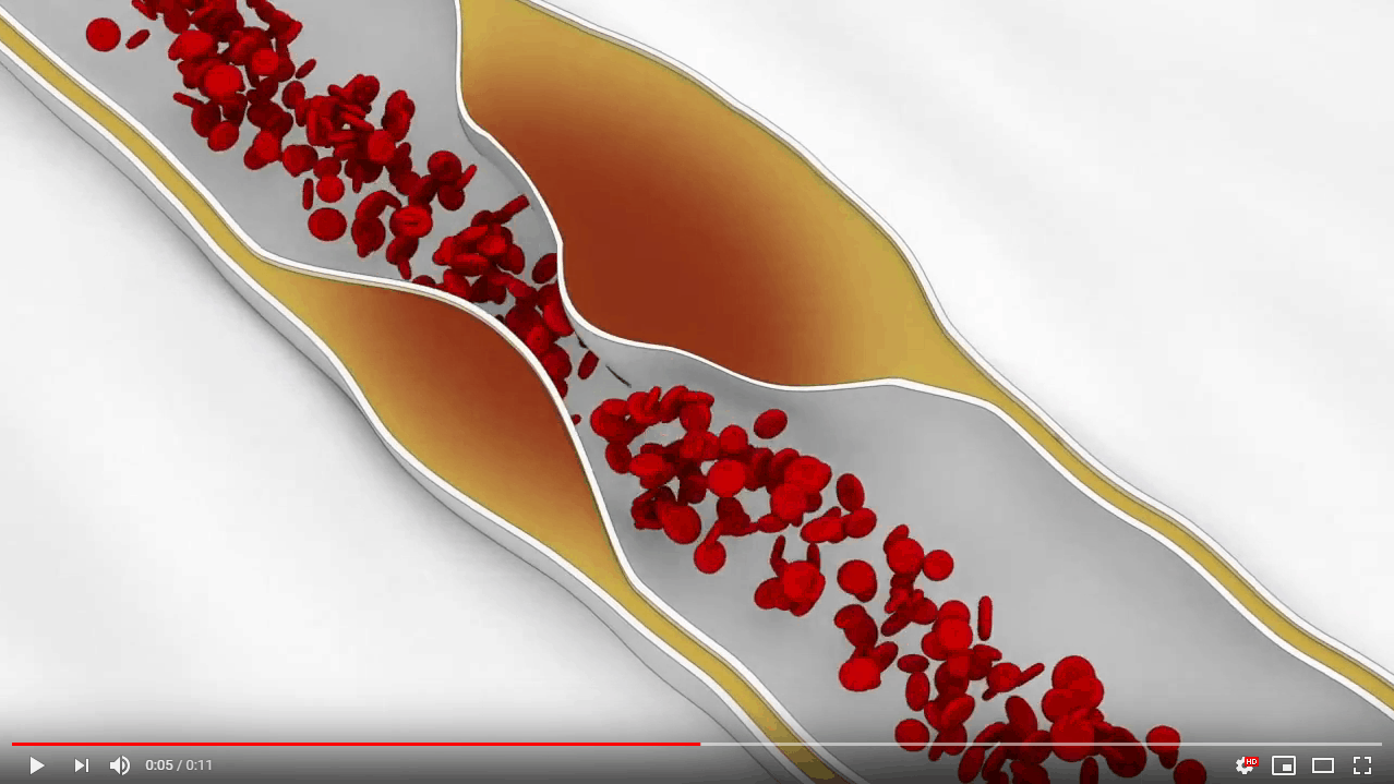 עורק בשלבי חסימה בעקבות טרשת עורקים