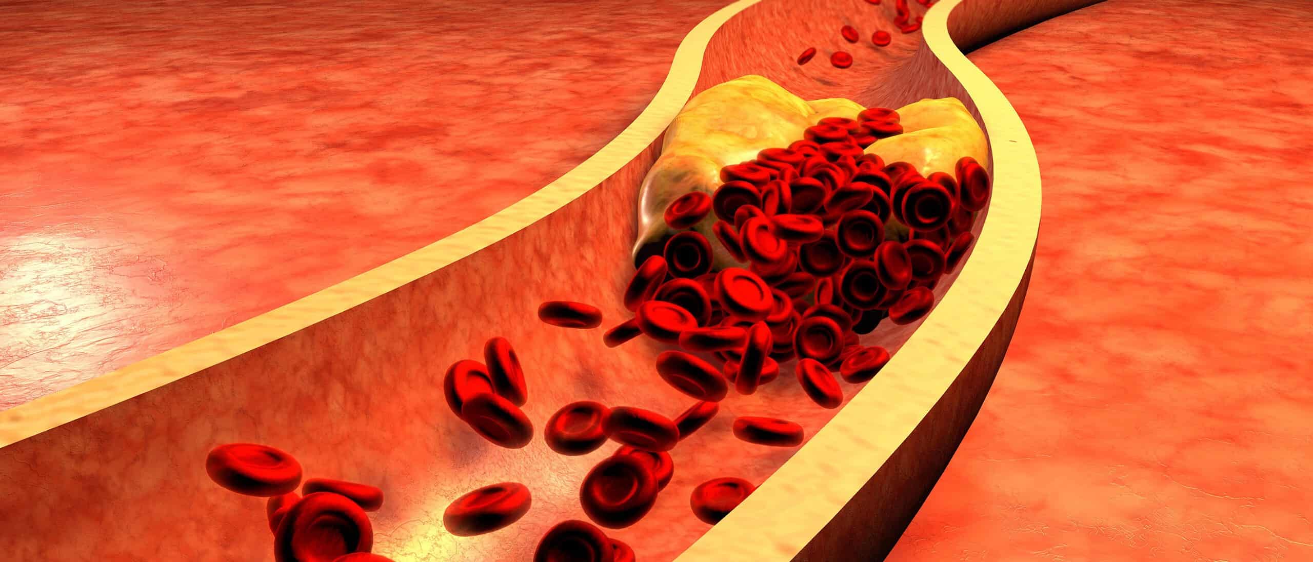 תרשים הממחיש התפתחות של טרשת עורקים בעורק
